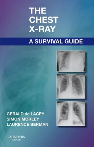 Amazon.com: Chest X-Ray Made Easy E-Book eBook : Corne MA, PhD, MB